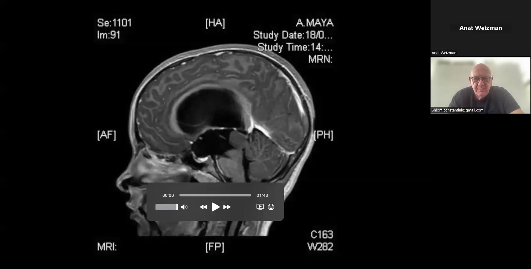 Endoscopic Third Ventriculostomy and Simultaneous Tumor Biopsy in Pineal Region