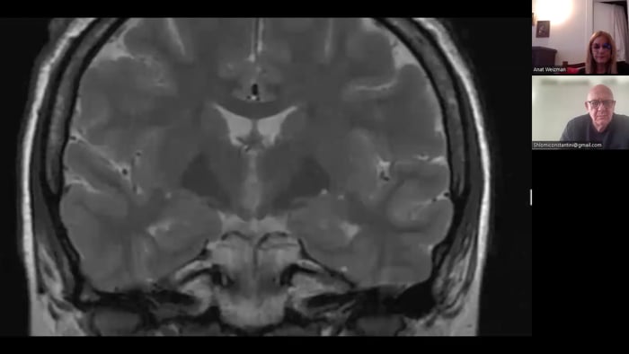 Hypothalamic Hamartoma Resection Combined Open and Endoscopic Removal