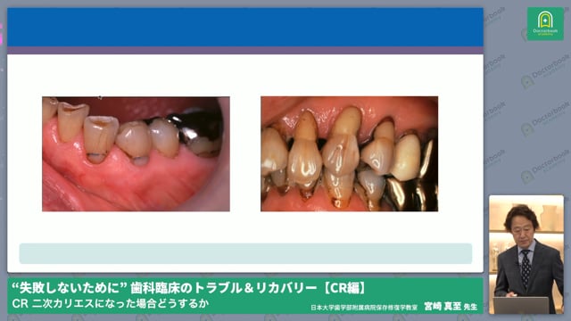 [保存修復]二次カリエスになった場合どうするか