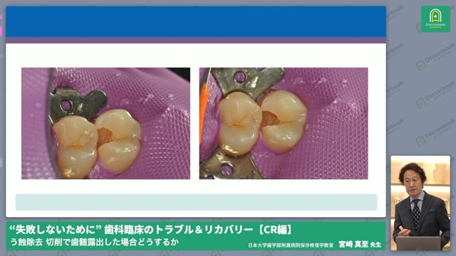 う蝕除去時の出血！！偶発露髄の対処法