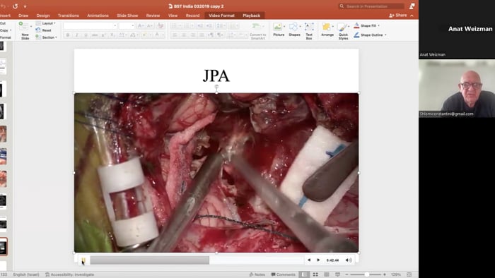 Massive Cervical Medullary (CV) Junction Juvenile Pilocytic Astrocytoma (JPA)