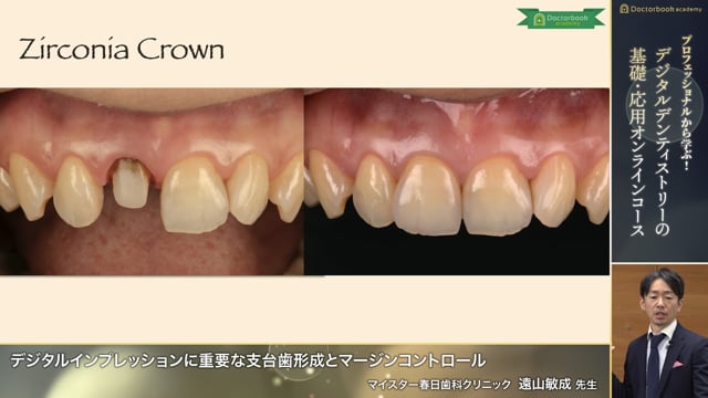 デジタルインプレッションに重要な支台歯形成とマージンコントロール