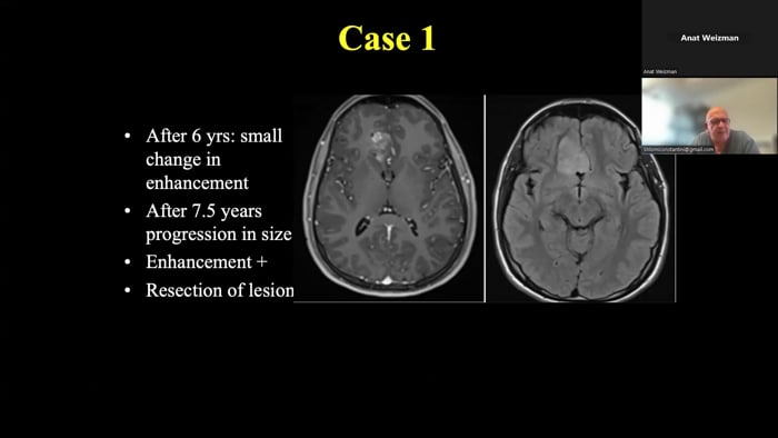 The Changing Spectrum of Pediatric Neuro-Oncology