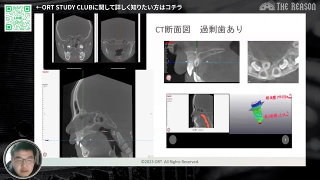 第14回 鼻閉による歯列不正・早期脱落が疑われる症例