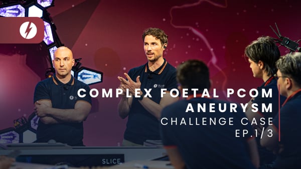 Complex foetal Pcom aneurysm - Ep.1/3