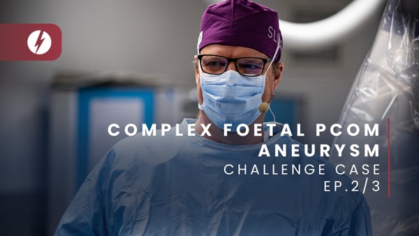 Complex foetal Pcom aneurysm - Ep.2/3