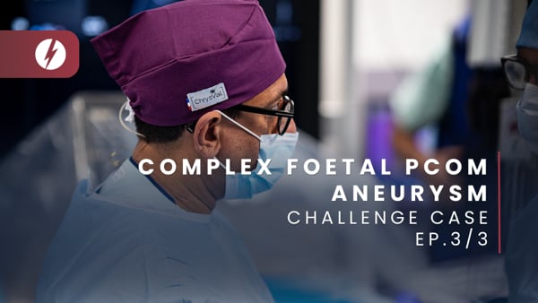 Complex foetal Pcom aneurysm - Ep.3/3