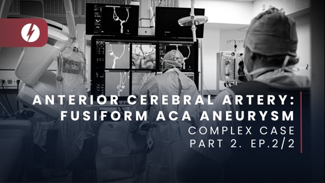 Anterior Cerebral Artery: Fusiform ACA aneurysm - Ep.2/2
