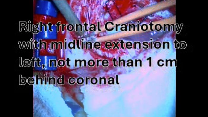 Total Corpus Callosotomy for intractable  Seizures