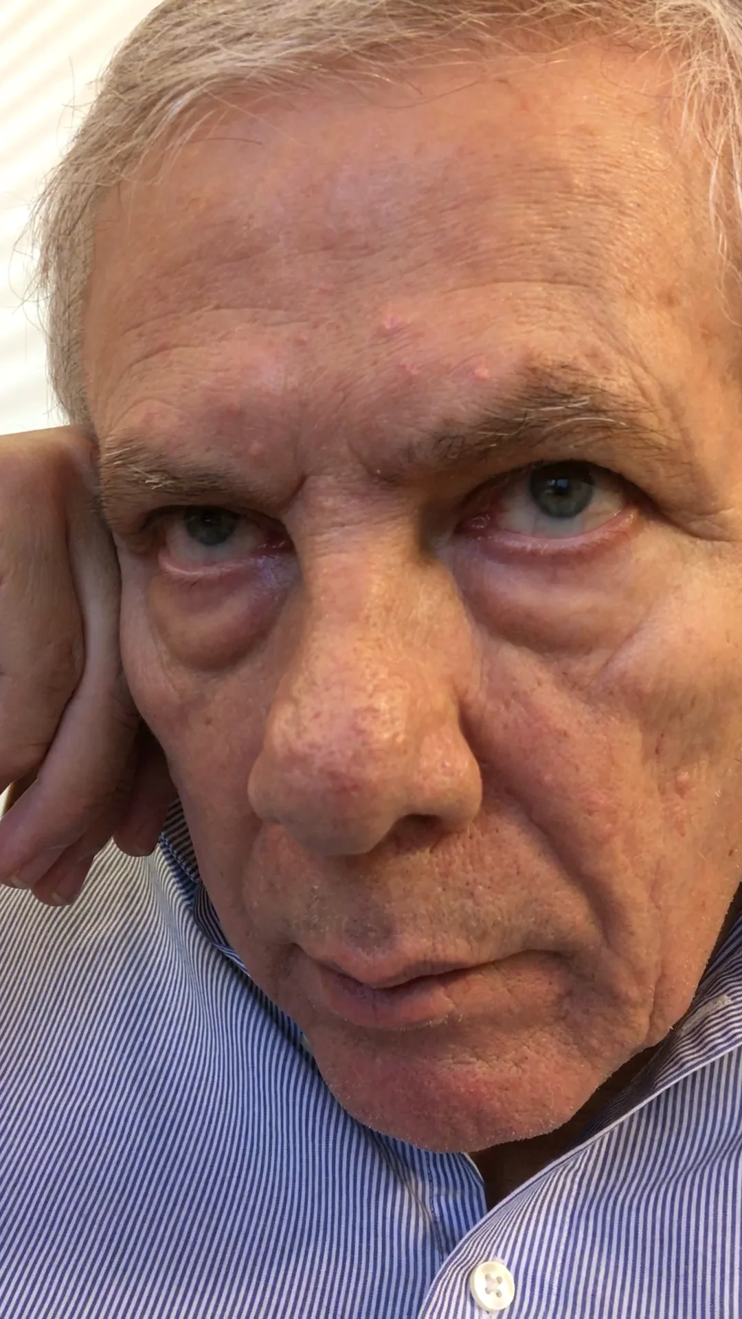 Multiple System Atrophy Patient Information