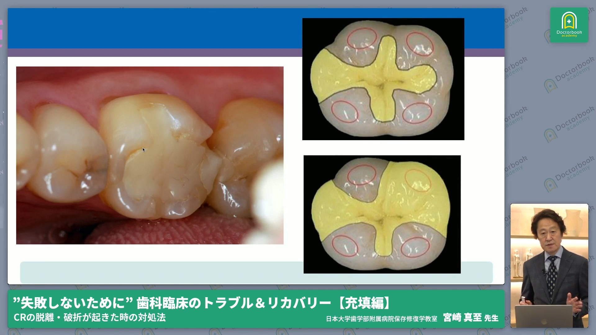 どうする？CR修復時の接着失敗（脱離/褐線/二次カリエス/破折）への対処法