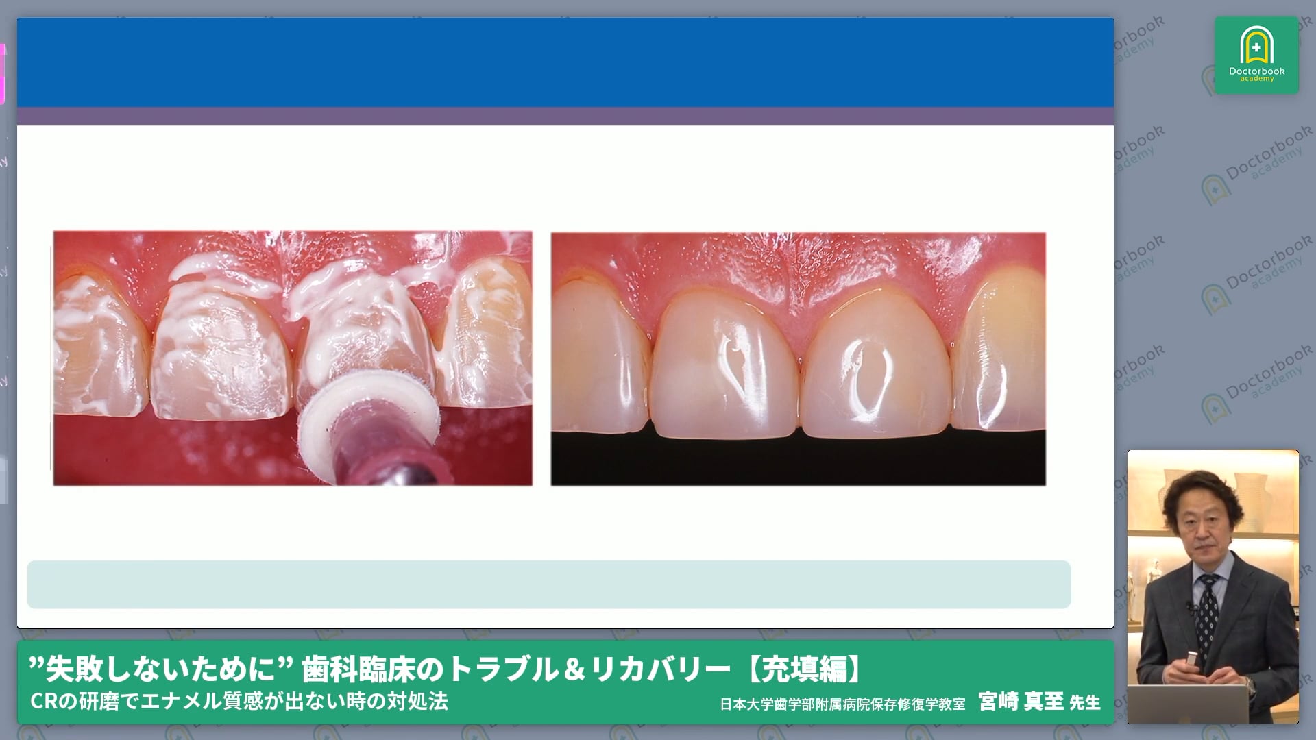 研磨時、エナメル質様の光沢感が出ない場合の対処法