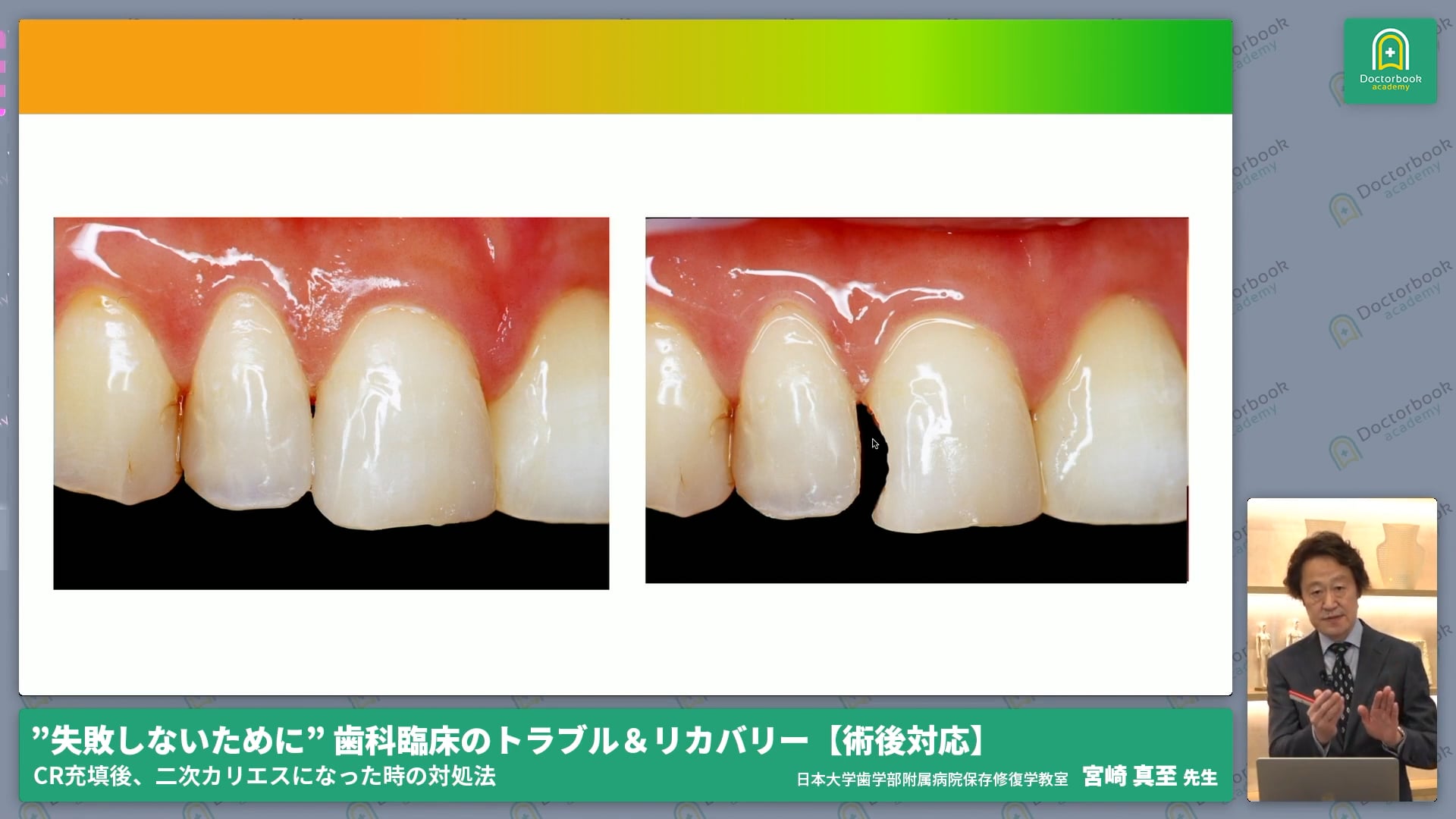 二次カリエスへの対処法｜確実な形態と長期的な管理こそ二次カリエス予防の基本！