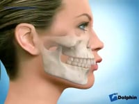 Class 2 Overjet Lip Procumbency