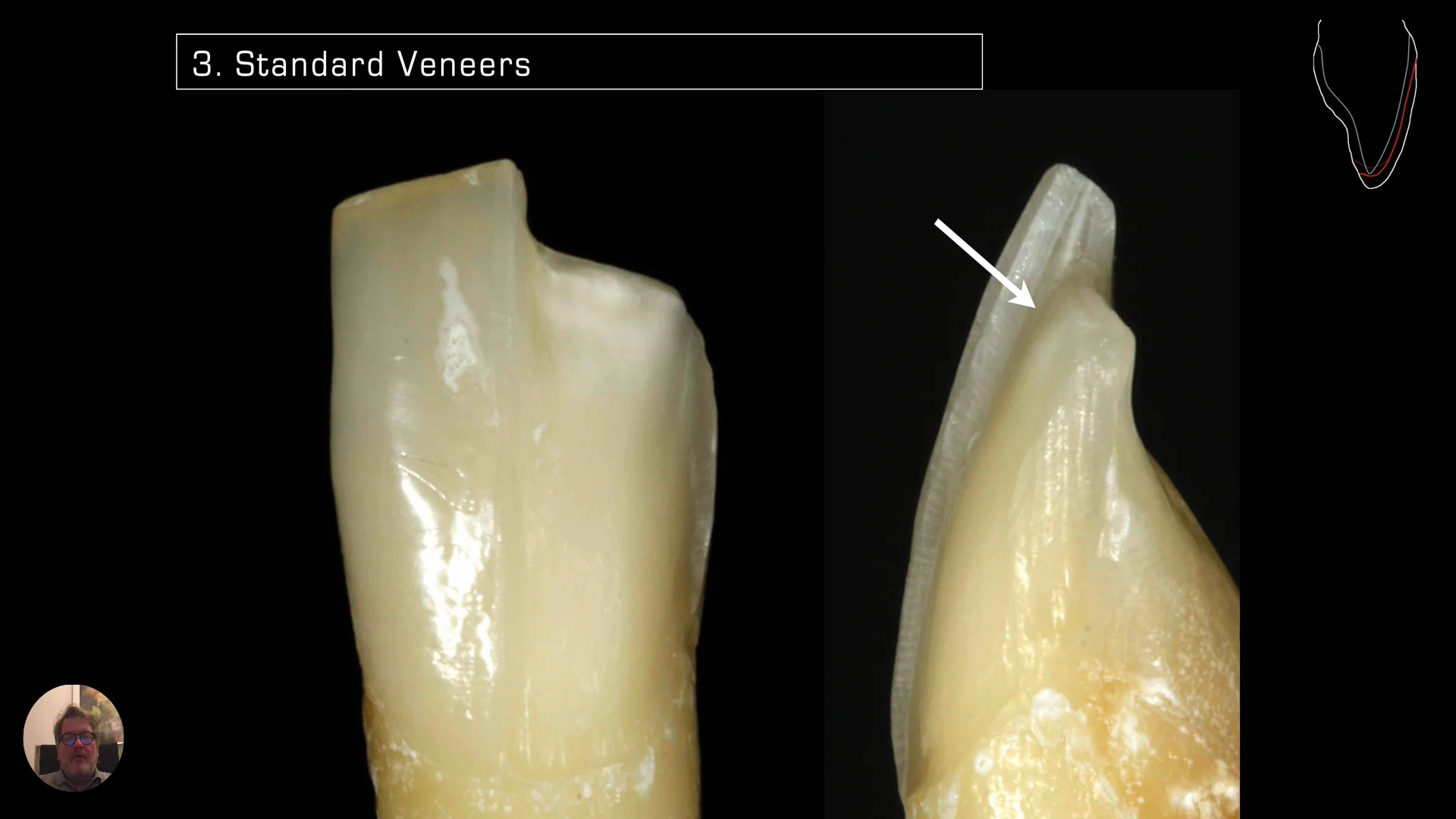 Material Selection of Ceramic Veneers and Marginal Adaptation