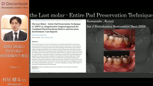新術式「L-EPPT」を応用した低侵襲な再生療法｜最後臼歯遠心骨内欠損の歯周組織再生療法 低侵襲な新術式「L-EPPT」を用いて #2