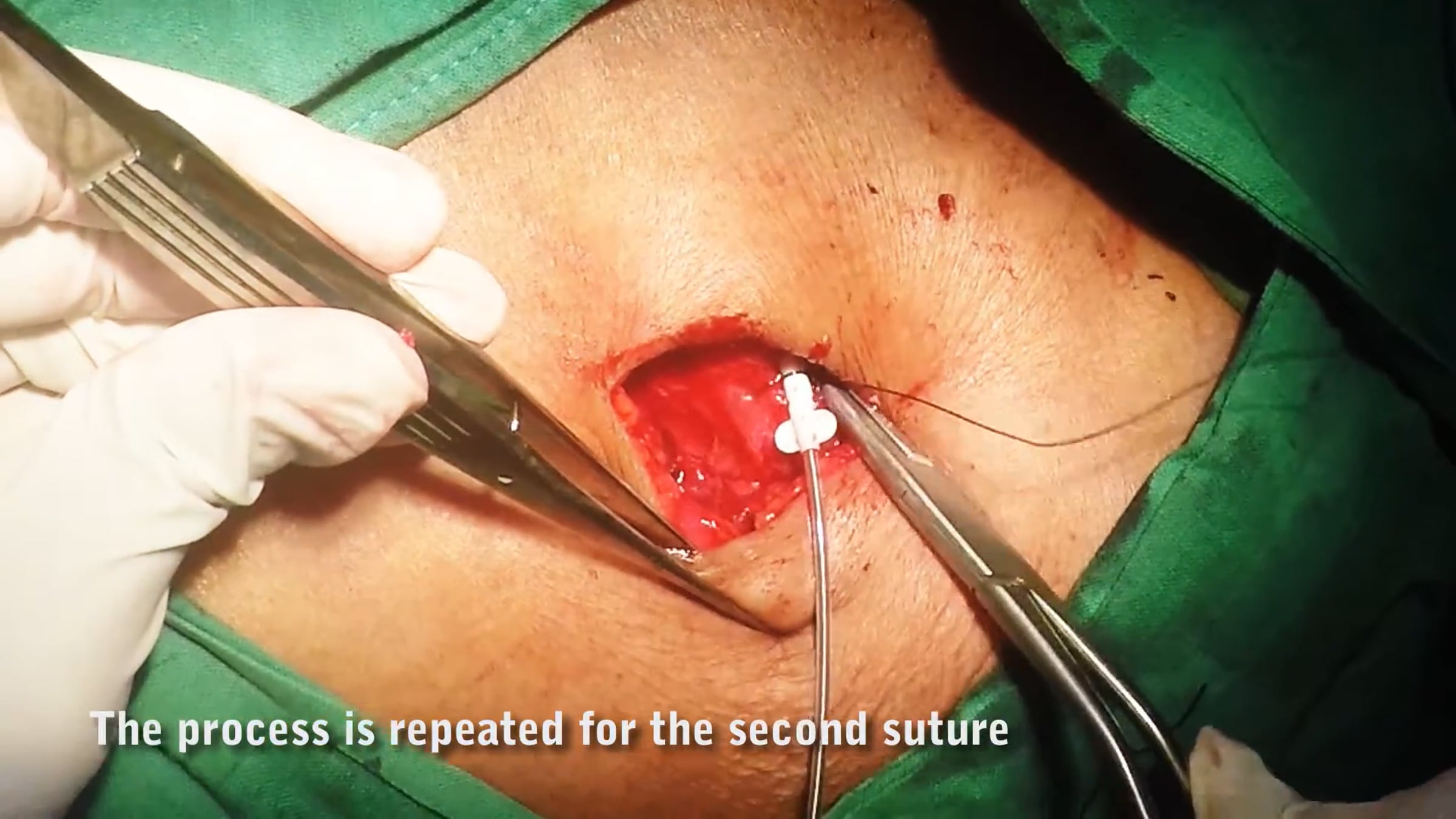 Anchoring of Pacemaker Lead to Pocket Floor | Videos & Movies on Vimeo