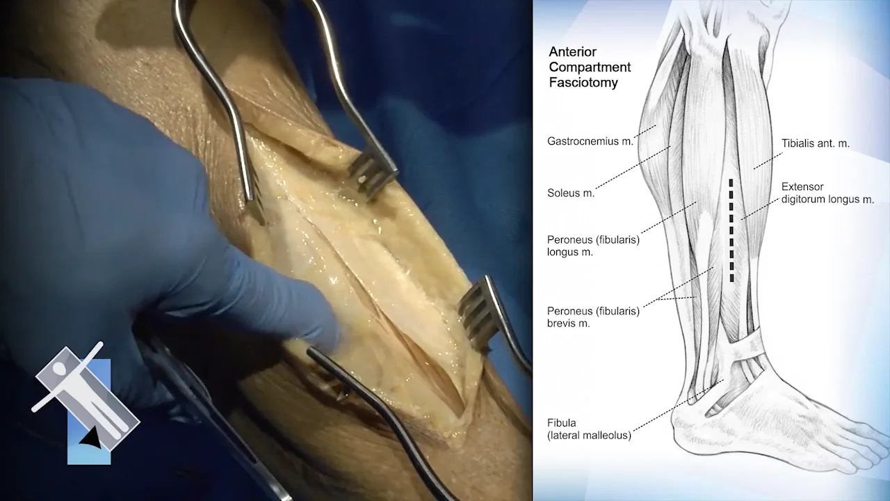 ch10 sec14 Fasciotomy on Vimeo