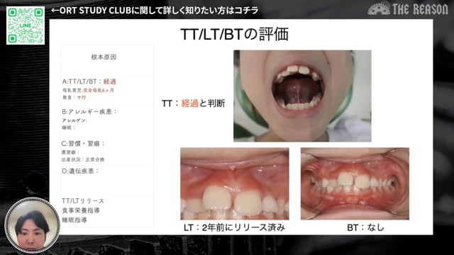 第15回 8歳女児2級咬合の矯正治療