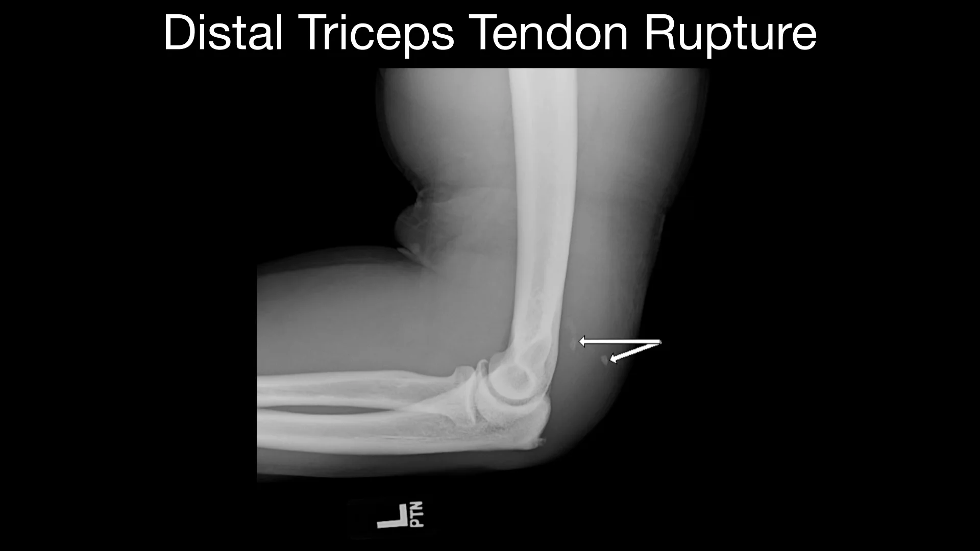 Distal Triceps Tendon Rupture on Vimeo