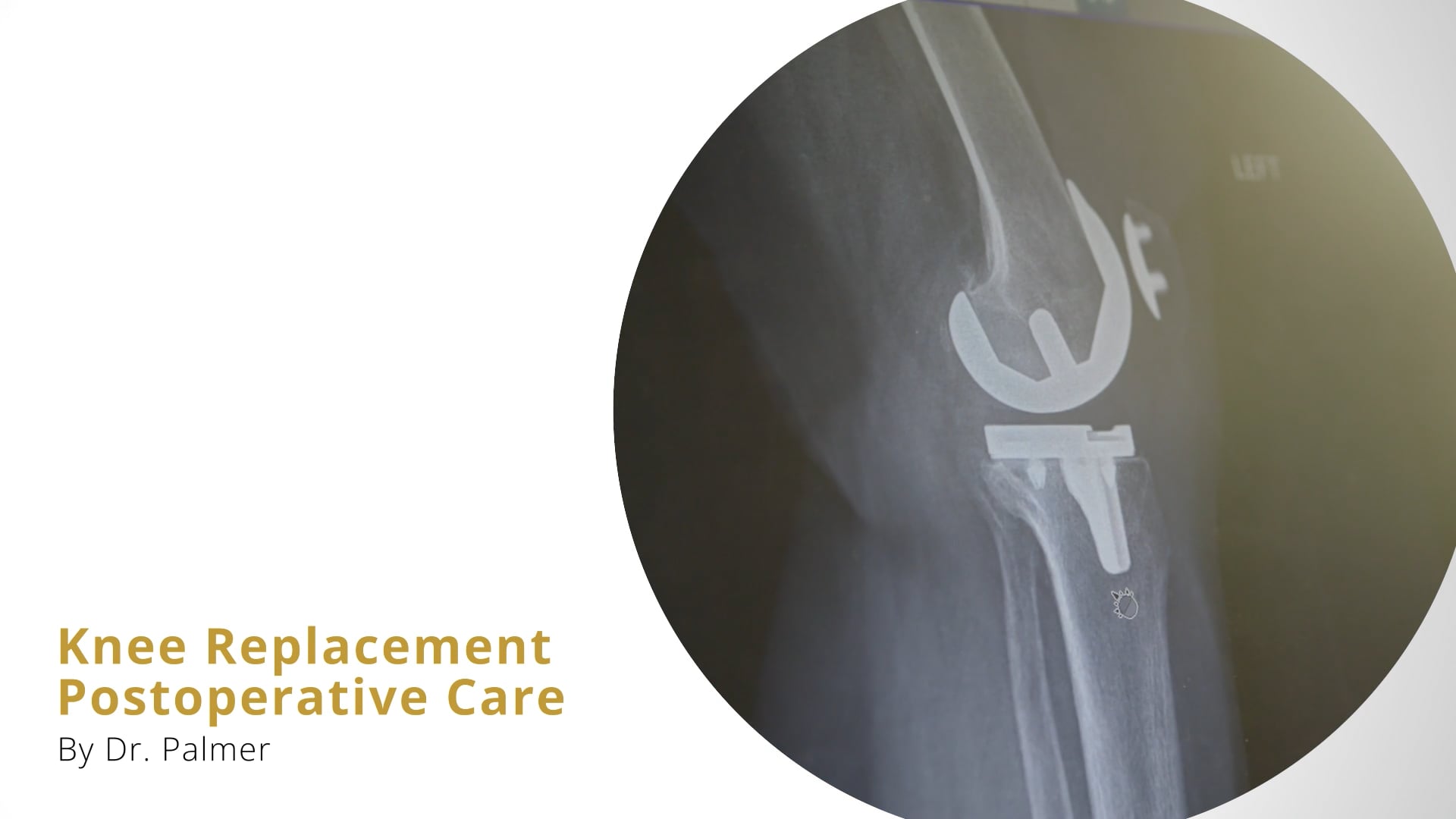 Knee Replacement Post-Op Instructions by Dr Palmer