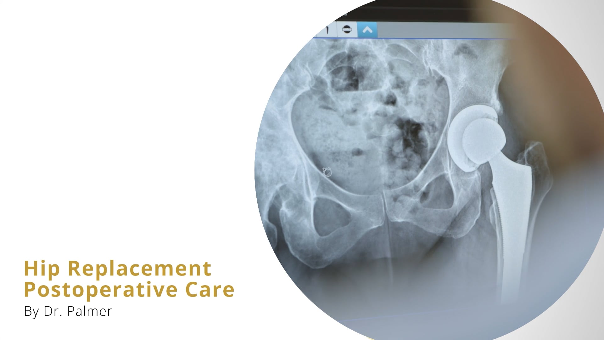Hip Replacement Post-Op Instructions by Dr Palmer