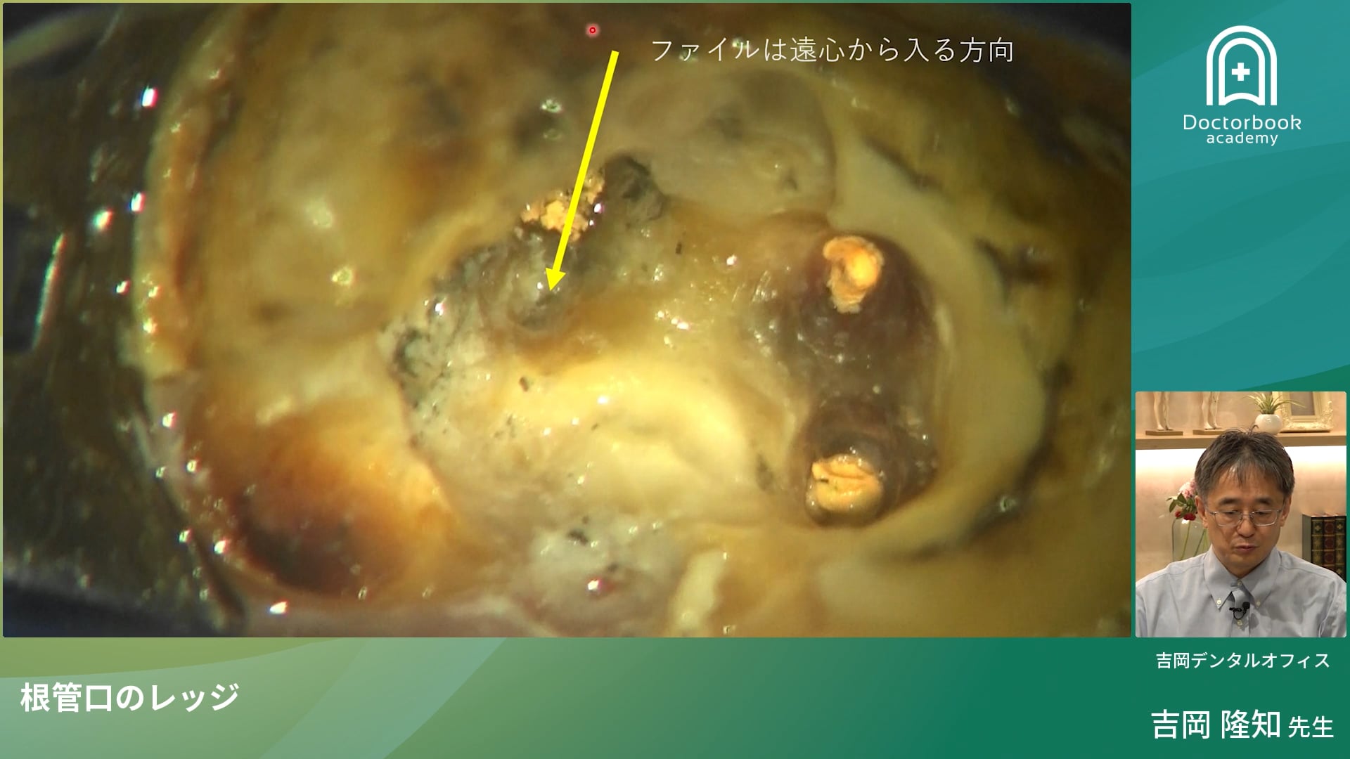 根管口のレッジへの対処法