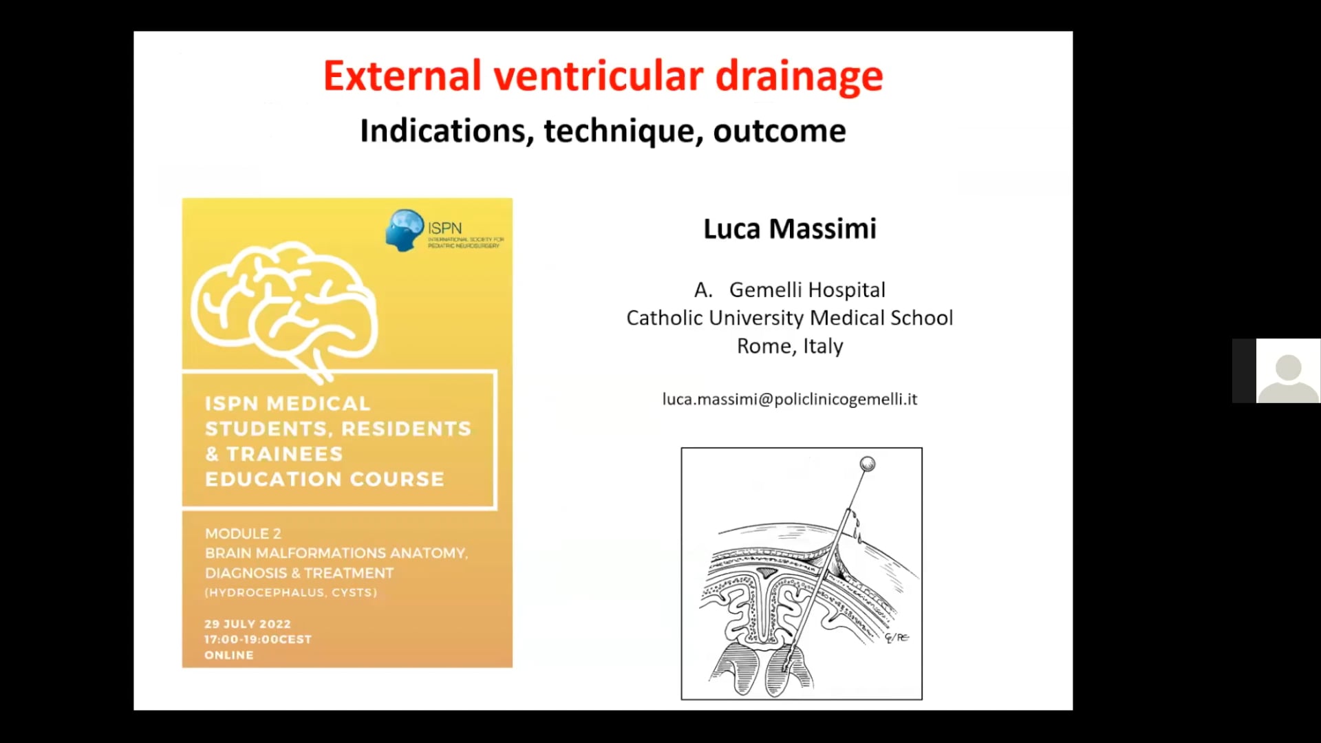 External Ventricular Drain EVD – Indications, Techniques, Outcomes