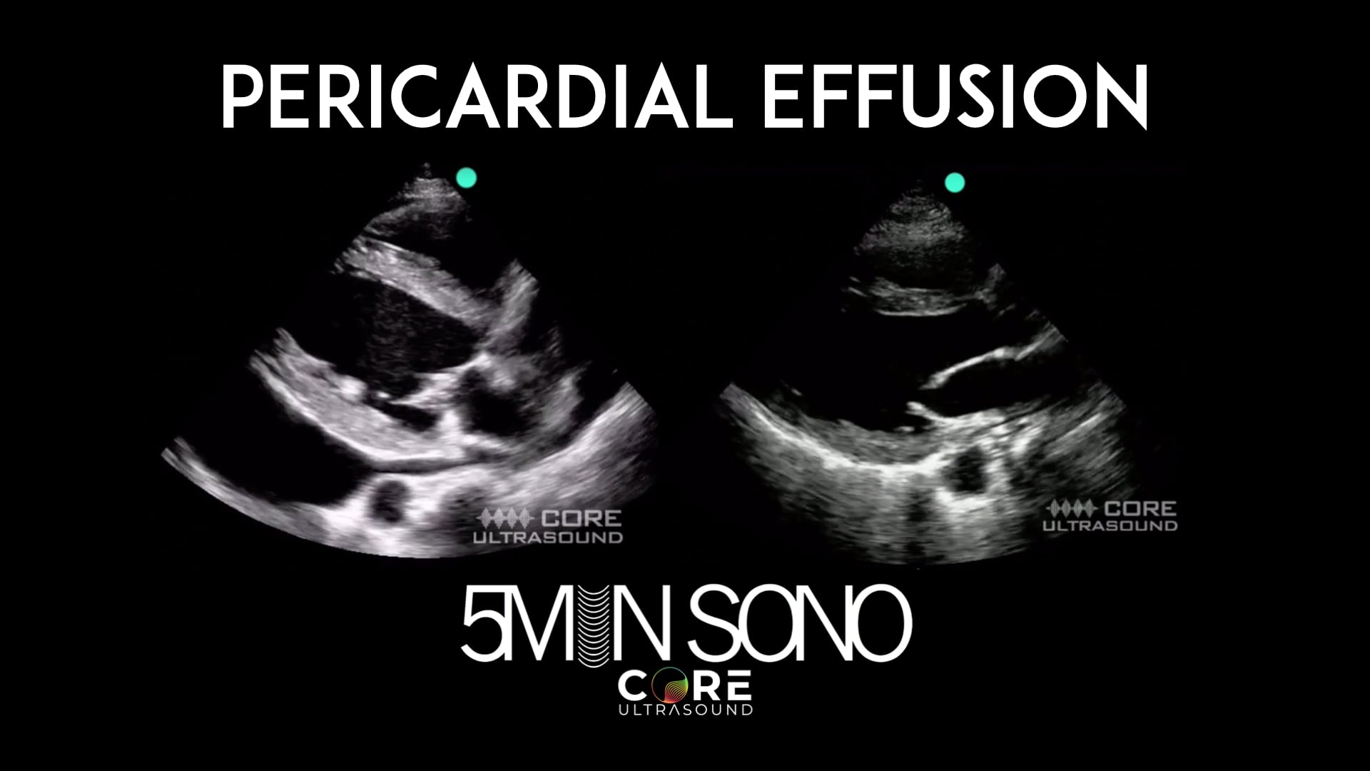 Image of 5 Min Sono – Pericardial Effusion