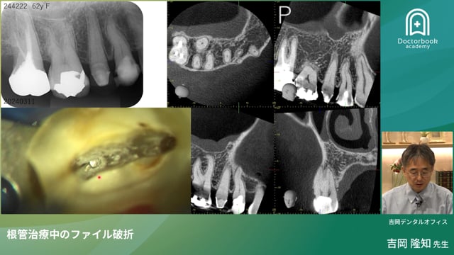 根管治療中のファイル破折への対処法