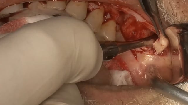 Guided Full Arch Surgery Video