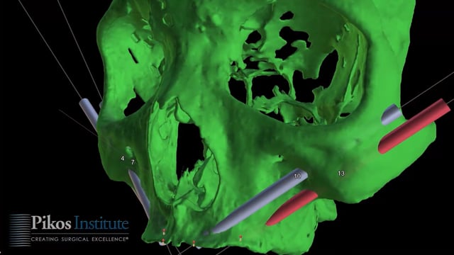 Medical Videography Zygomatic Implant Guide