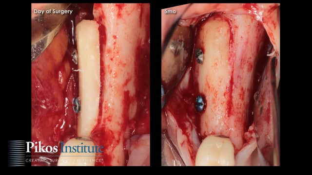 Bone Grafting Surgery Video