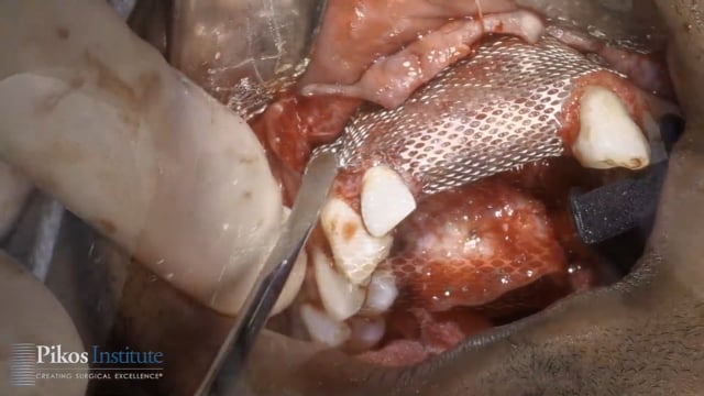Oral Surgery Videography