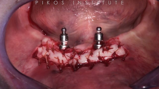 Soft Tissue Graft Surgery