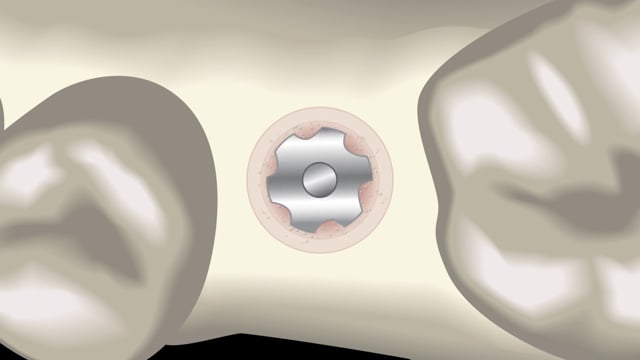 Surgical Procedure Animation