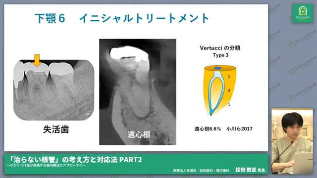 症例から見る下顎大臼歯の根管治療～中央根管への対応～ #3