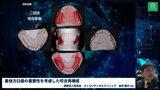 最後方臼歯の重要性を考慮した咬合再構成｜全顎治療の最前線"カッティングエッジ" 基調講演