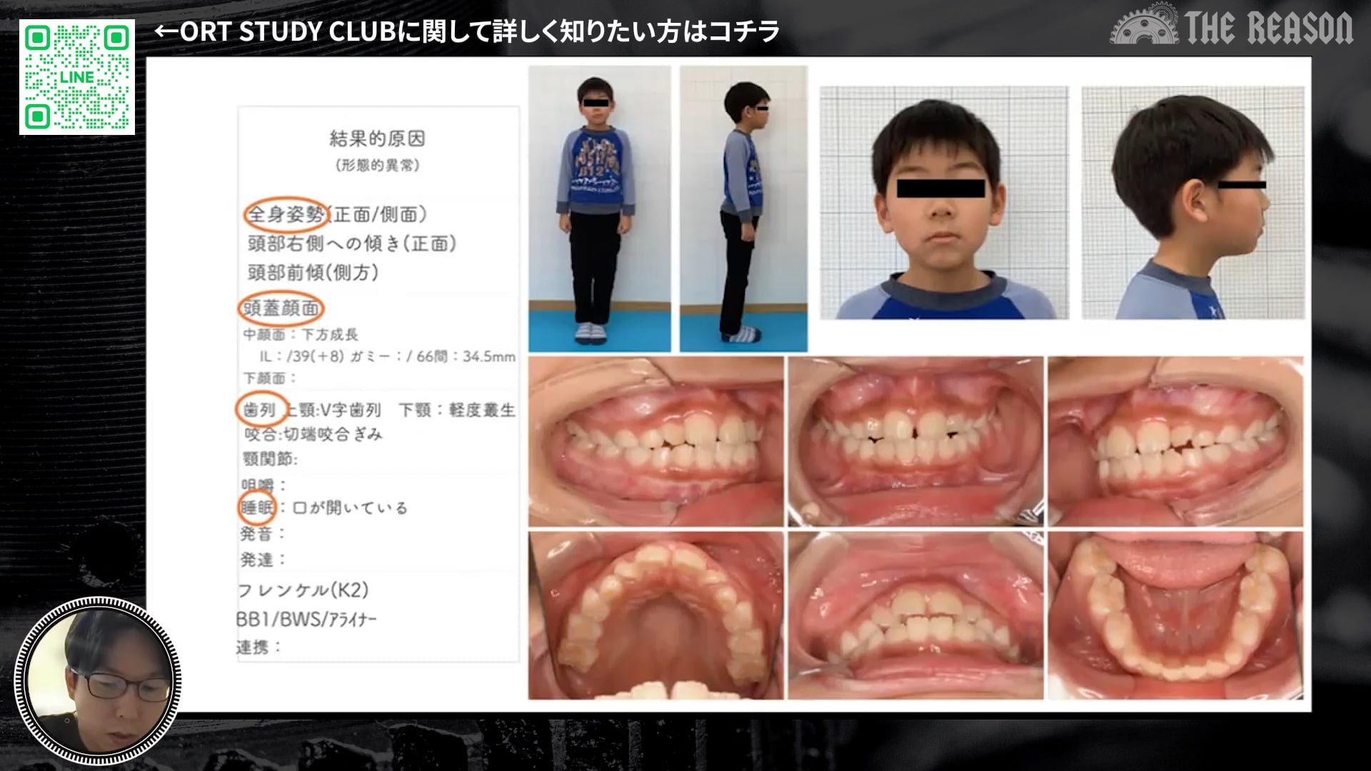 第16回 前歯部後戻りにより機能性反対咬合となった症例