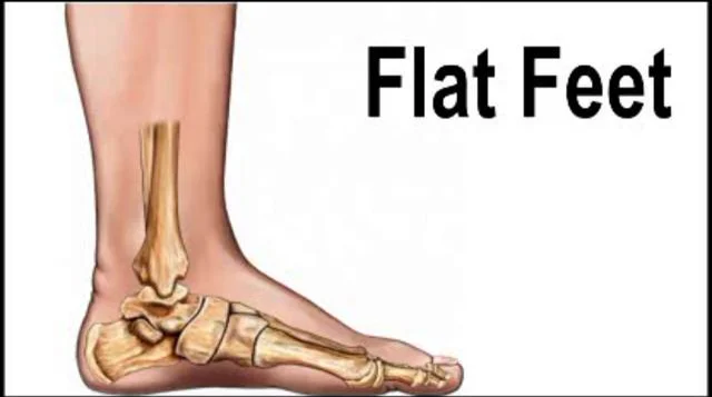 Flexible Flatfoot Needs Adjustable Treatment Methods - Wheat Ridge, CO &  Arvada, CO: Rocky Mountain Foot & Ankle Center