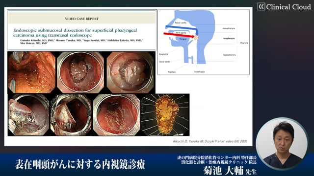 表在咽頭癌の早期発見と治療 今後の課題