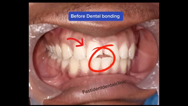 DENTAL BONDING
