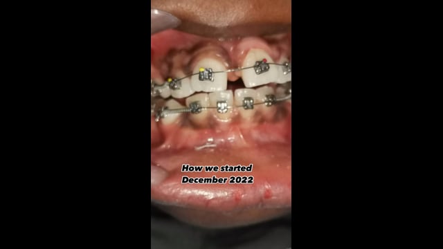 Dental transformation using braces! (1)