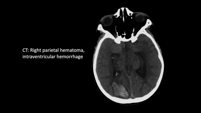 The Use of Surgical Theater to Facilitate Resection of an Arteriovenous Malformation