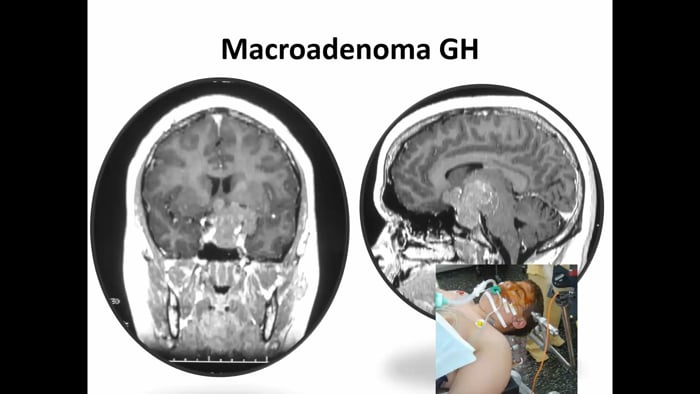 Pituitary Tumors in Children