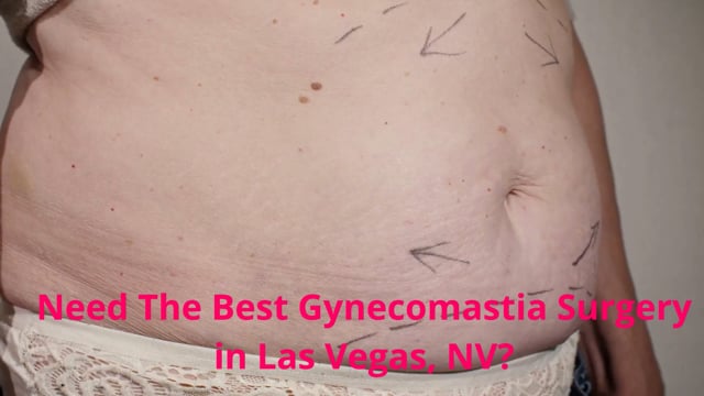 Premier Liposuction : Professional Gynecomastia Surgery in Las Vegas, NV