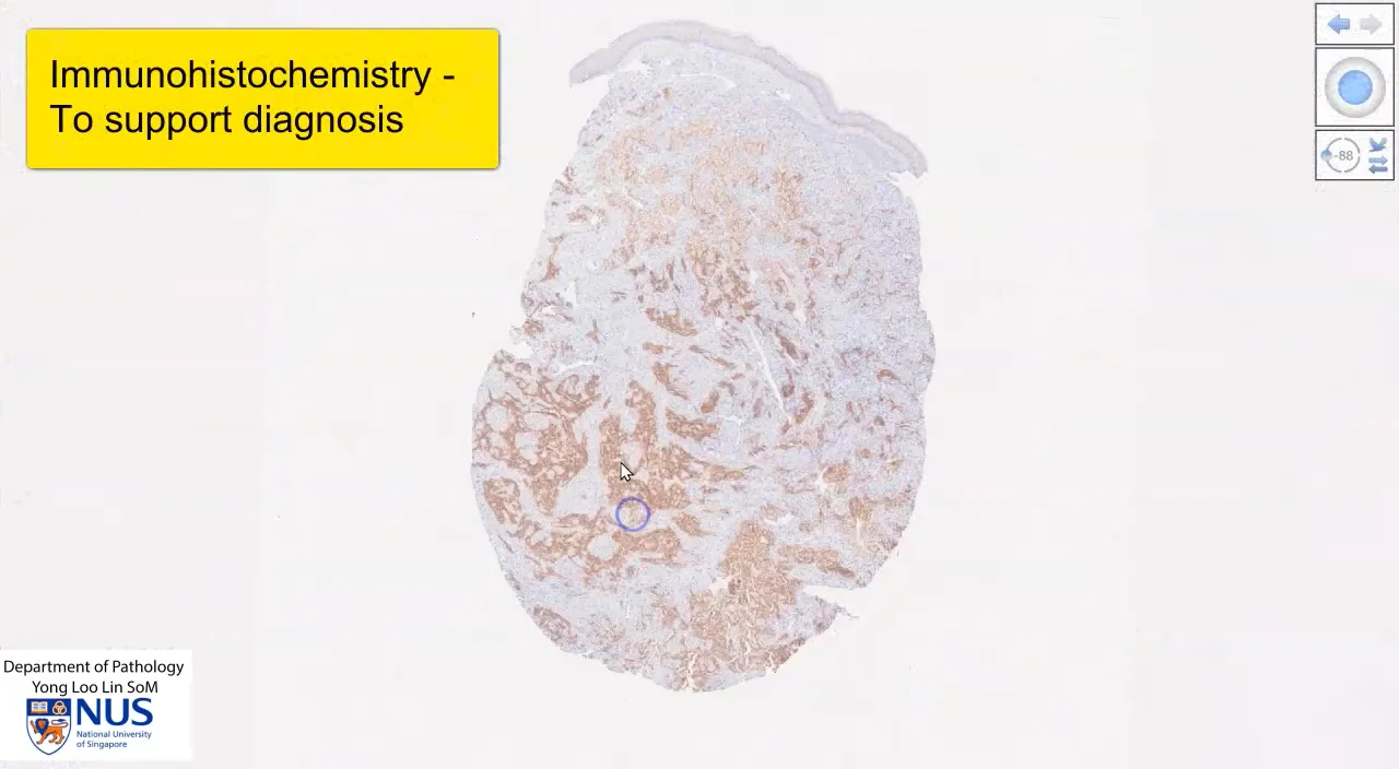 Skin - Metastatic renal cell carcinoma on Vimeo