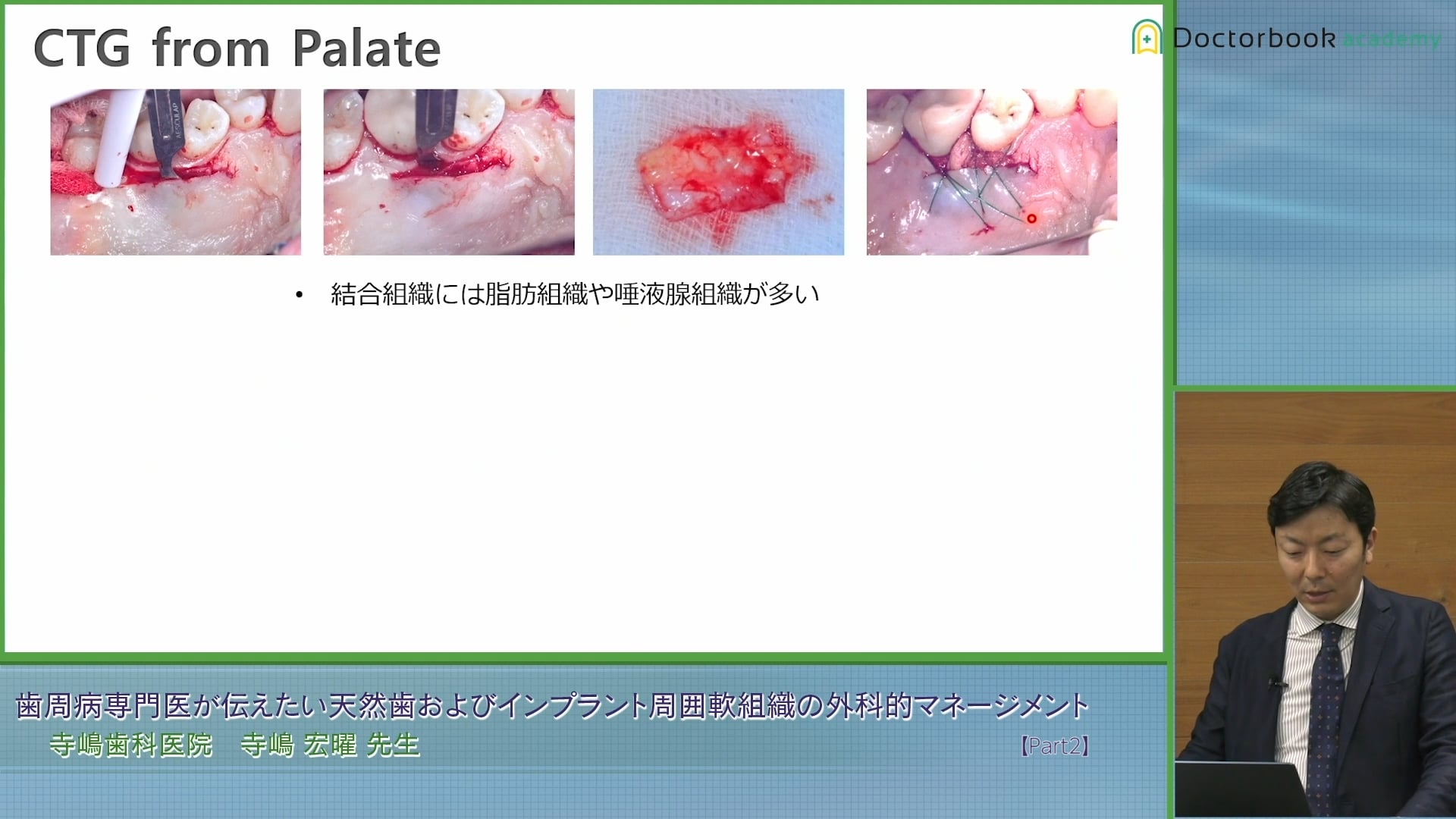 結合組織移植術：CTG | Doctorbook academy (ドクターブック