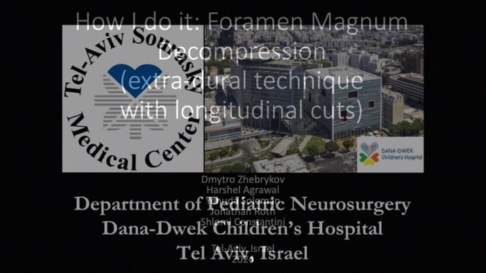 How I do It: Foramen Magnum Decompression: Extradural Technique