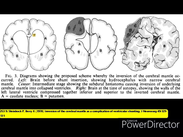 Cysto Ventriculostomy for Shunt Induced Arachnoid Cyst